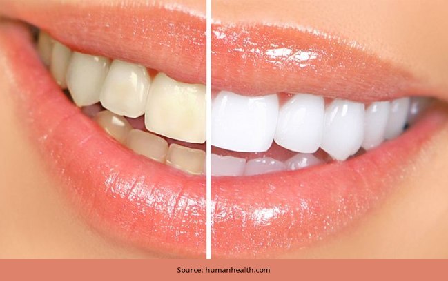 5-Inexpensive-Home-Remedies-for-Whiter-Teeth