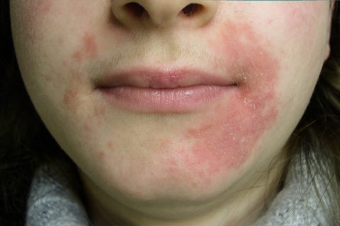 Maskitis