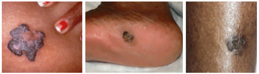 skin-cancer-melanoma-black-people